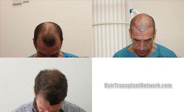 Top view - Before and after surgical hair replacement