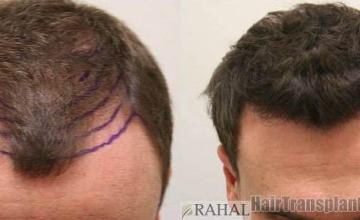 Top view before and after hair restoration results