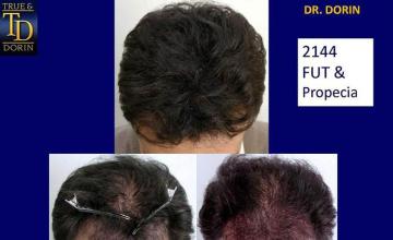 Top view - Before and after surgical hair replacement