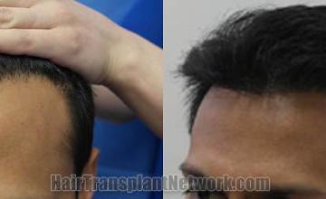 Hair transplantation surgery before and after pictures