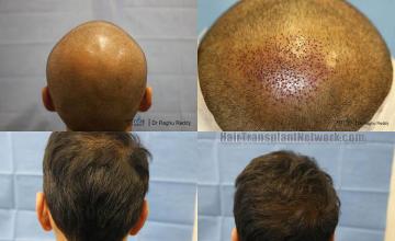 Hair restoration procedure before and after pictures