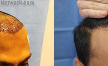 Hair transplantation surgery before and after images