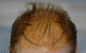 Patient prepped for hair restoration procedure