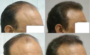 Hair transplantation before and after photographs