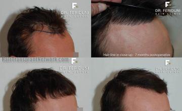 Before and after hair restoration procedure