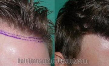 Right view - Before and after surgical hair restoration