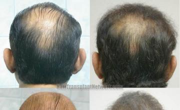 Hair restoration procedure images with Finasteride