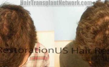 Before and after hair restoration procedure result photos