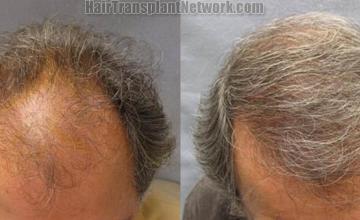 Hair transplantation surgery before and after images