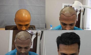 Hair transplantation surgery before and after photos