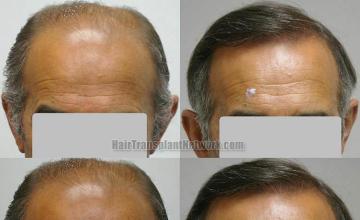 Front view before and after hair restoration photos