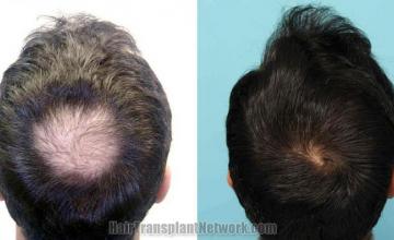 Hair restoration before and after photographs