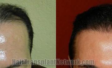 Hair restoration procedure before and after results