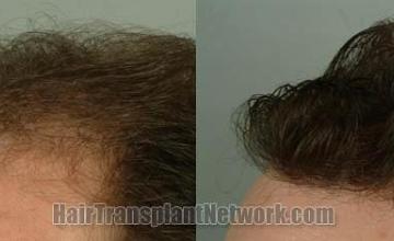 Hair transplantation surgery result images