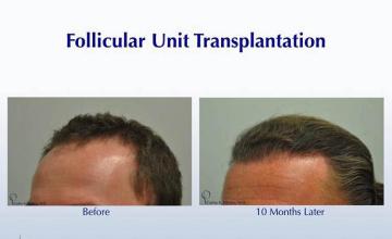 Hair transplantation surgery before and after pictures