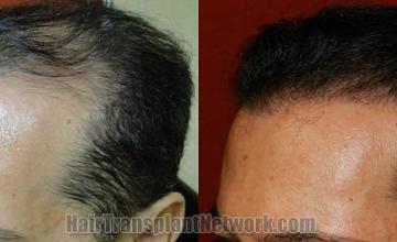 Hair transplantation surgery before and after pictures