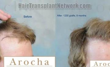 Hair transplantation surgery before and after images