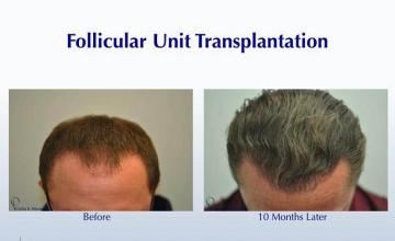 Hair transplantation surgery before and after photos