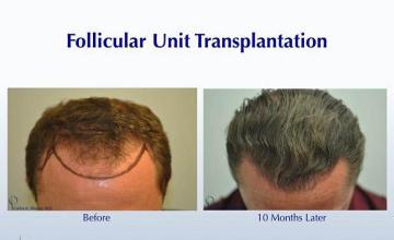 Hair restoration surgery before and after photos