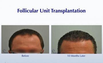 Hair restoration procedure before and after results