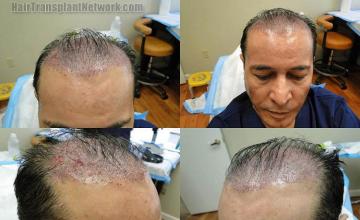 Hair restoration procedure before and after pictures