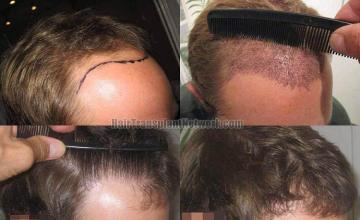 Hair restoration procedure before and after results