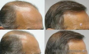 Hair transplant procedure before and after photos