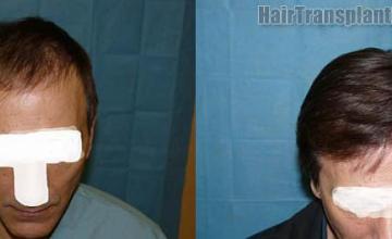 Top view - before and after hair transplantation images