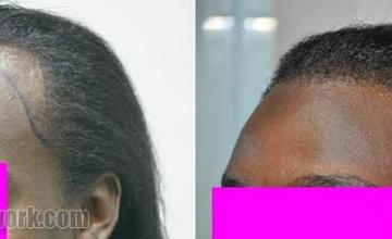 Left view before and after hair restoration procedure