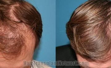 Before and after hair restoration pictures