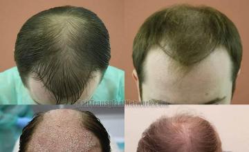 Hair restoration procedure before and after pictures