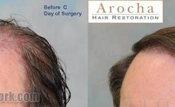 Hair restoration procedure result images before and after