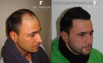 Right view before and after hair transplantation