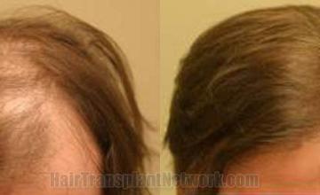 Hair transplantation surgery before and after photos