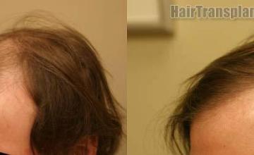 Hair restoration procedure before and after pictures