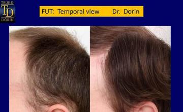 Surgical hair transplantation result photographs