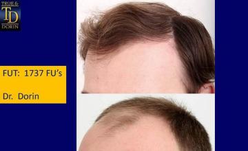 Hair restoration procedure before and after pictures