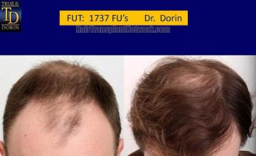 Top view before and after hair restoration results