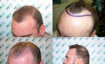 Hair restoration procedure before and after pictures