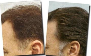 Hair restoration procedure results
