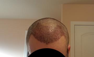 Three days after the hair transplant