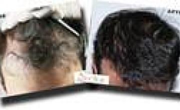 Top view before and after hair restoration results