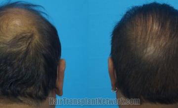 Back view before and after hair transplantation 