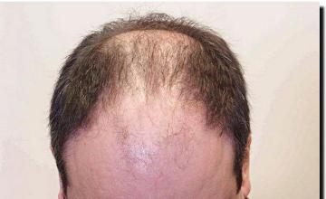 Hair restoration procedure results