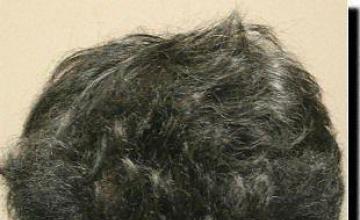 Hair restoration procedure results