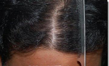 Hair restoration procedure results