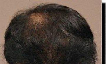 Hair restoration procedure results