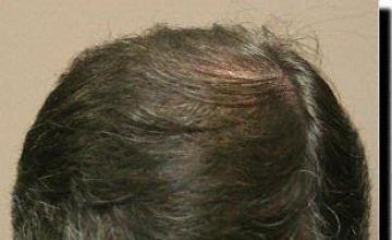 Hair restoration procedure results