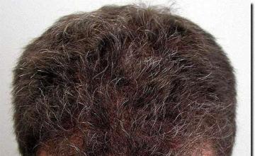 Hair restoration procedure results