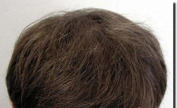 Hair restoration procedure results